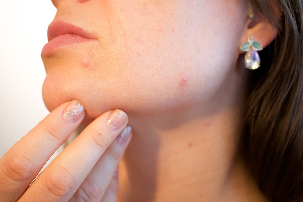 woman with acne